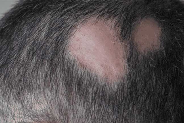 Homeopathy Hair Fall & Dandruff Doctor in Pimpri