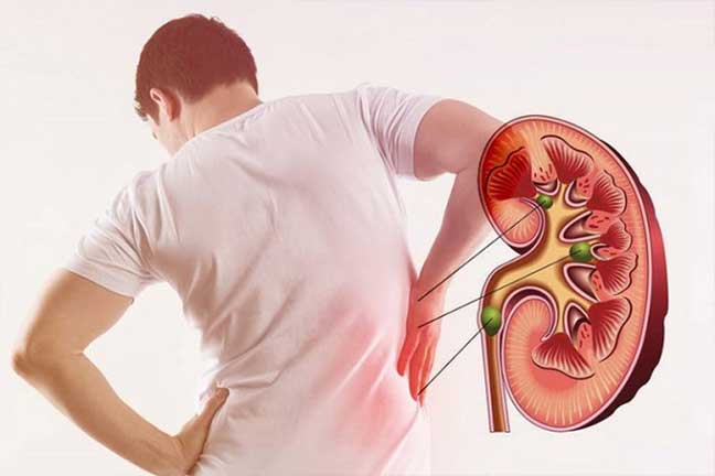 Homeopathy Calculi Treatment in Pimpri