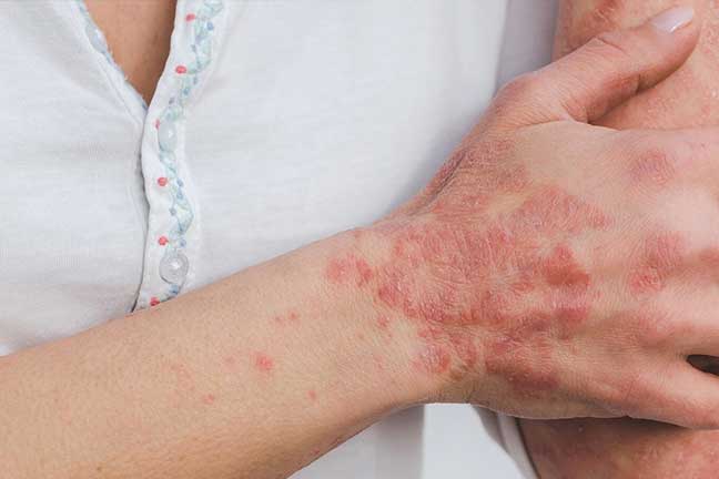 Homeopathy Skin Treatment/clinic in Pimprii