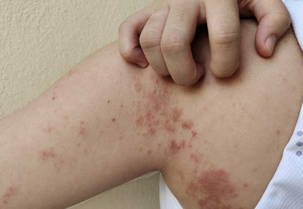 Homeopathy Treatment for Autoimmune Disorders in Pimpri – Natural Immune Support
