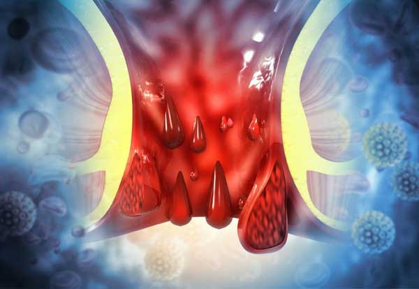 Homeopathy Piles and Fissure Treatment in Pimpri – Padma Homeopathic Clinic