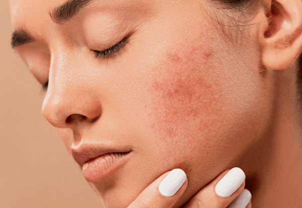 Homeopathy Skin Treatment in Pimpri – Acne, Eczema, Psoriasis Care