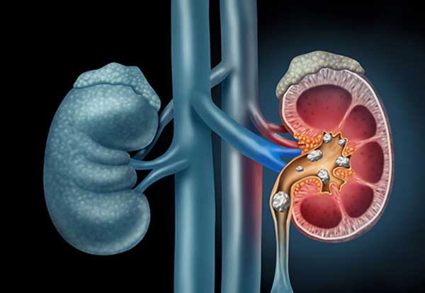 Homeopathy Kidney Stone and Calculi Treatment in Pimpri – Padma Clinic